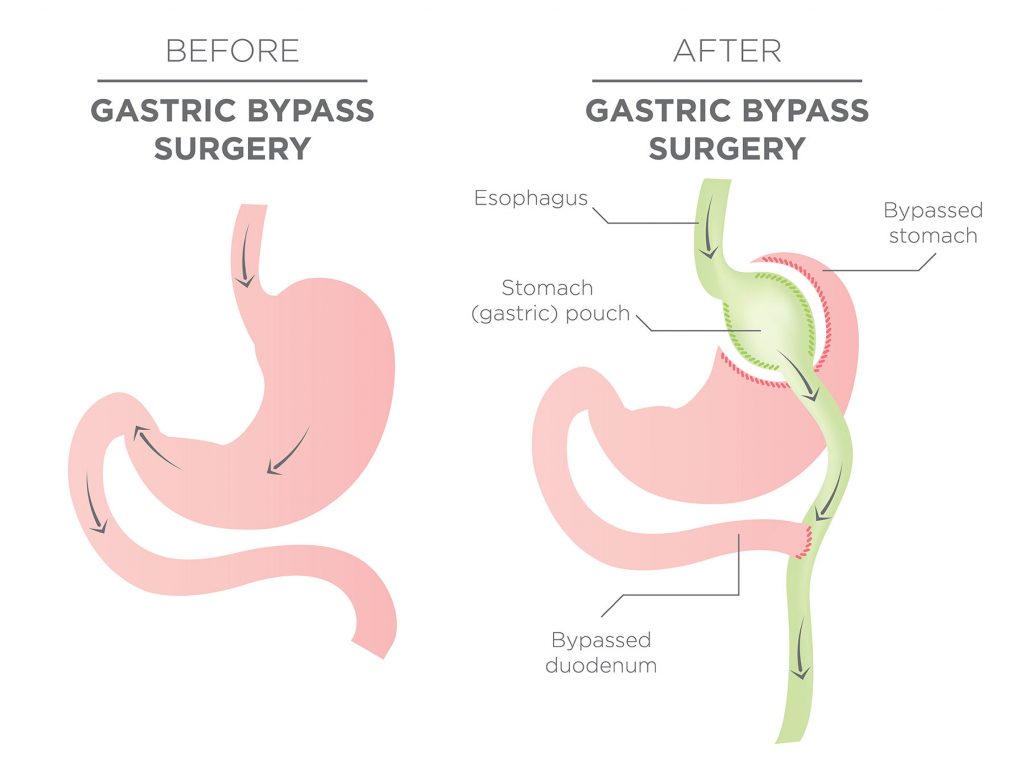 gastric bypass