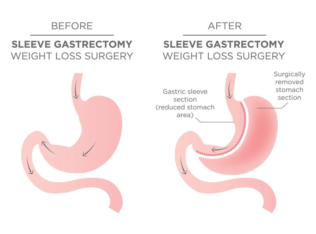 sleeve gastrectomy